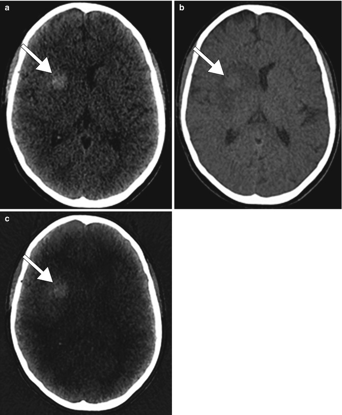 Iodinated Contrast Agents Neupsy Key Iodinated Contrast Agents Neupsy Key