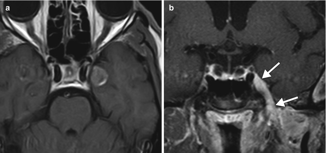 Ipilimumab (MDX-010, Yervoy) | Neupsy Key