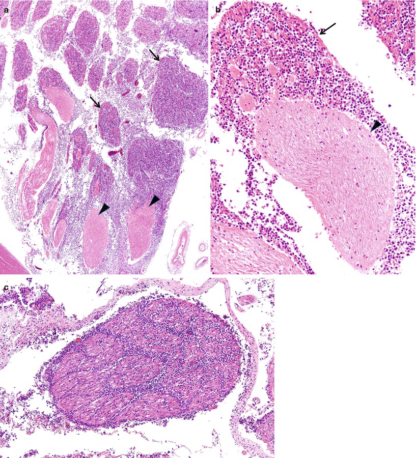 Neuropathy Associated With Neoplasia | Neupsy Key