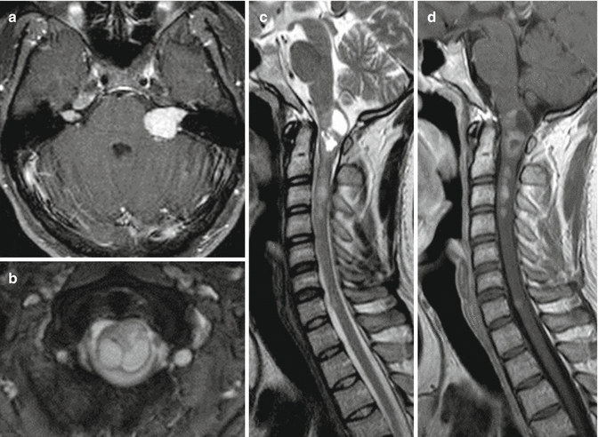 Neurofibromatosis Type 1 And Type 2 | Neupsy Key