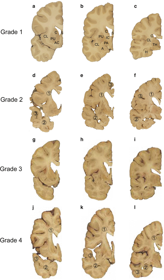 The Neuropathological Grading Of Huntington’s Disease (HD) | Neupsy Key