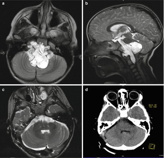 Chordomas and Chondrosarcomas | Neupsy Key