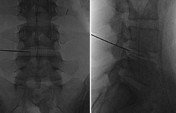 Full-Endoscopic Lumbar and Cervical Surgery for Disc Herniation ...