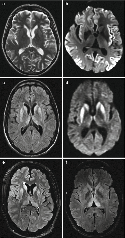 Prion Diseases Neupsy Key