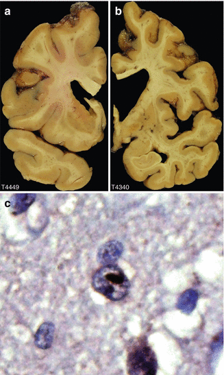 Huntington’s Disease | Neupsy Key