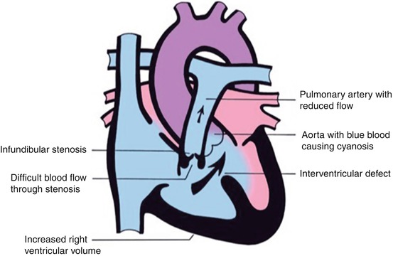 Congenital Heart Disease: A Medical Overview | Neupsy Key