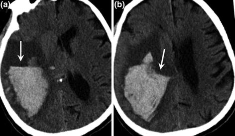 Thrombolysis | Neupsy Key