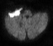 Extra-Axial Masses | Neupsy Key