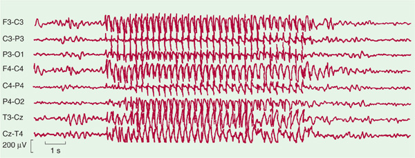 distinguish a seizure from a syncopal episode postictal