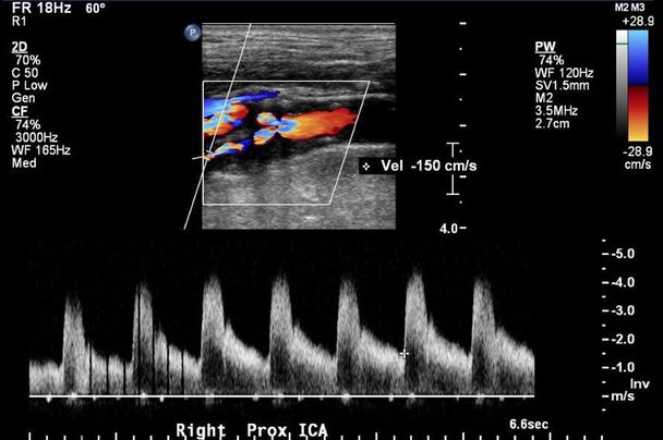 Choosing the right patients for carotid artery procedural interventions ...