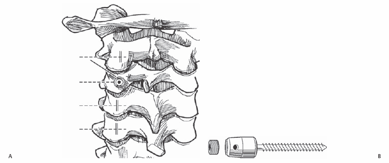 Cervical Lateral Mass Screw Placement C3c7 Neupsy Key