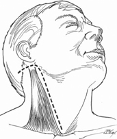 Anterior C1, C2 Arthrodesis: Lateral Approach of Barbour and Whitesides ...