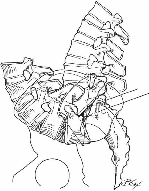 Reduction Of High Grade Spondylolisthesis Neupsy Key