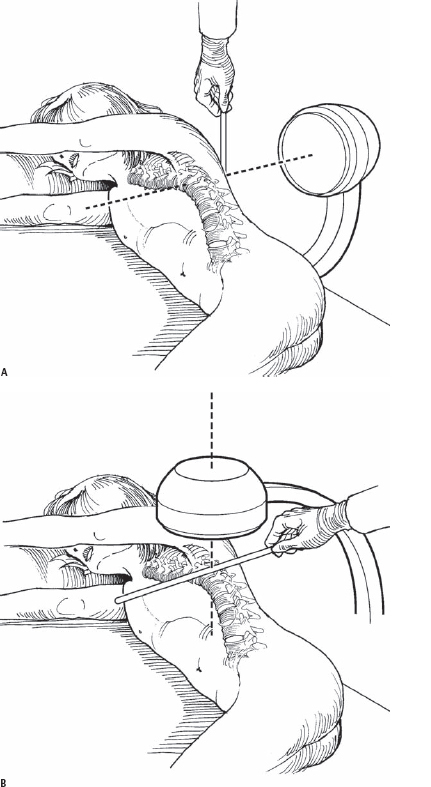 Intervertebral Stapling for Spinal Deformity | Neupsy Key