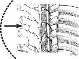 Posterior Rib Osteotomy For Rigid Coronal Spinal Deformities | Neupsy Key