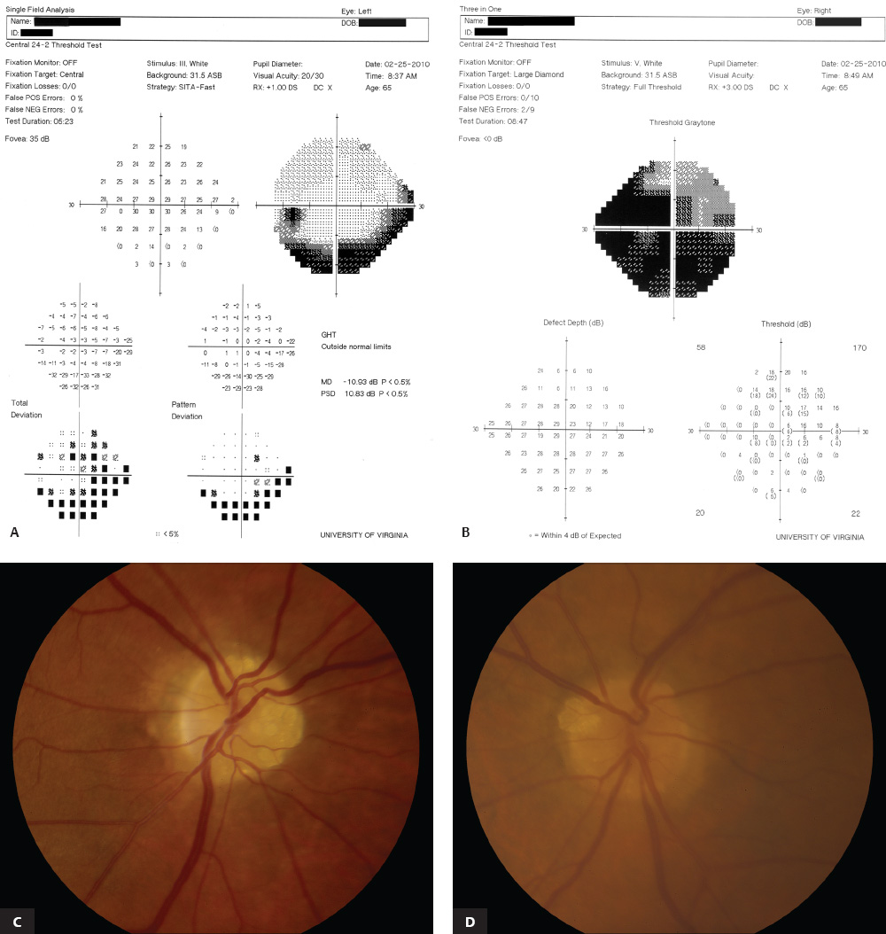 Amsler's Chart- Procedure, Prerequisites, Scotoma, Interpretation,  Documention. (Video-2) 