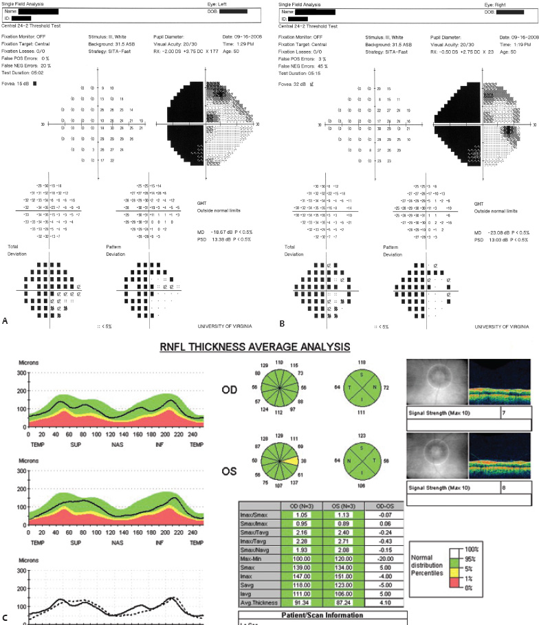 Amsler's Chart- Procedure, Prerequisites, Scotoma, Interpretation,  Documention. (Video-2) 