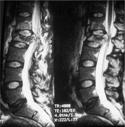 Anterior Thoracolumbar Screw-Rod Instrumentation | Neupsy Key