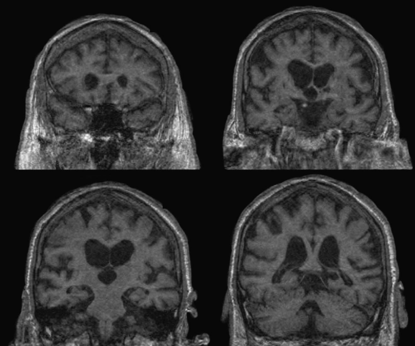 Four coronal T1-weighted MRIs presenting moderate 2+ hippocampal atrophy on Scheltens scale and moderate cerebral atrophy.