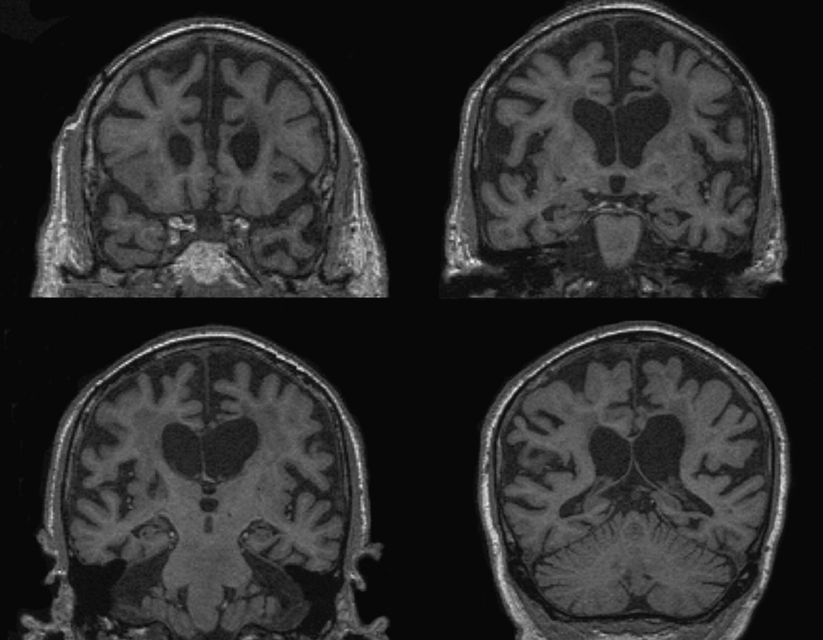 Four coronal T1‐weighted MRIs presenting 3+ atrophy by Scheltens’ scale of the hippocampus and severe cerebral atrophy.