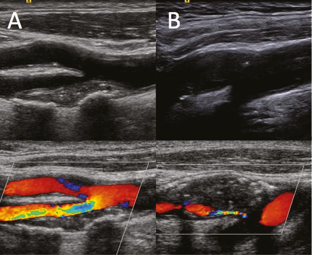 cost of carotid doppler