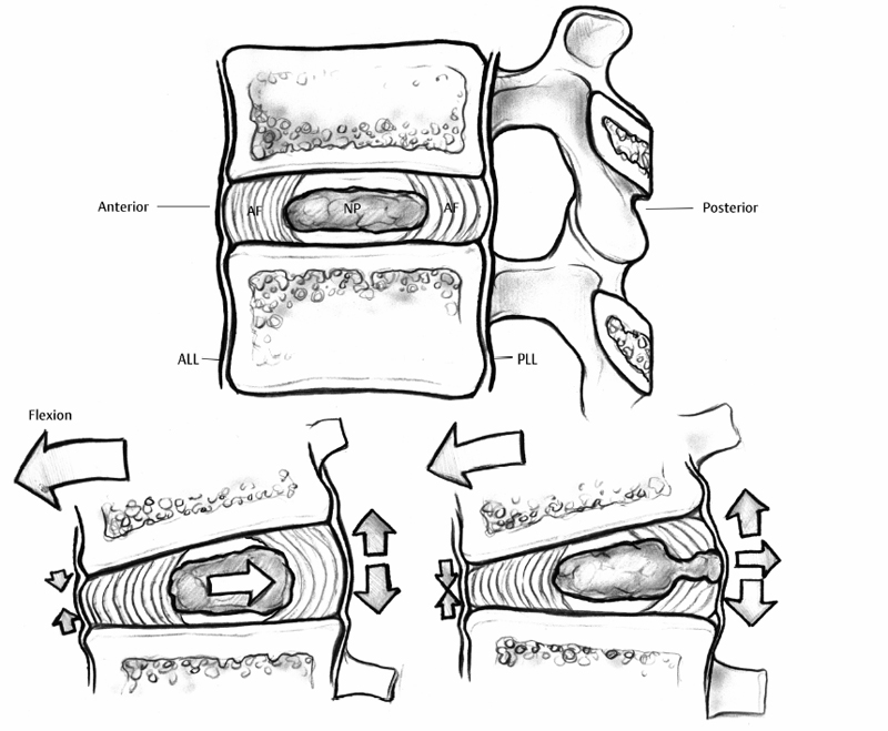 Pathophysiology and Etiology of Intervertebral Disc Herniation | Neupsy Key