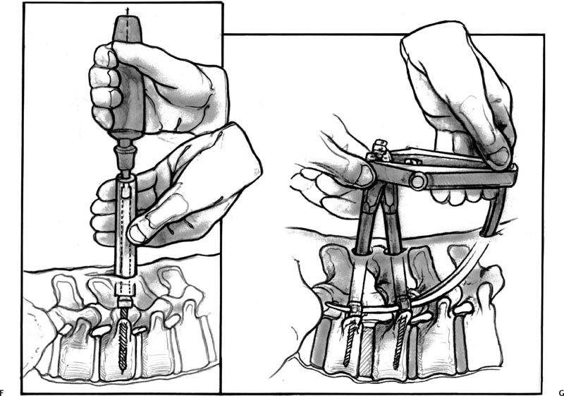 Minimally Invasive Spinal Fusion Procedures | Neupsy Key