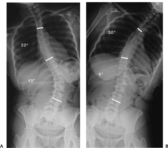 Overview of Spinal Deformity | Neupsy Key