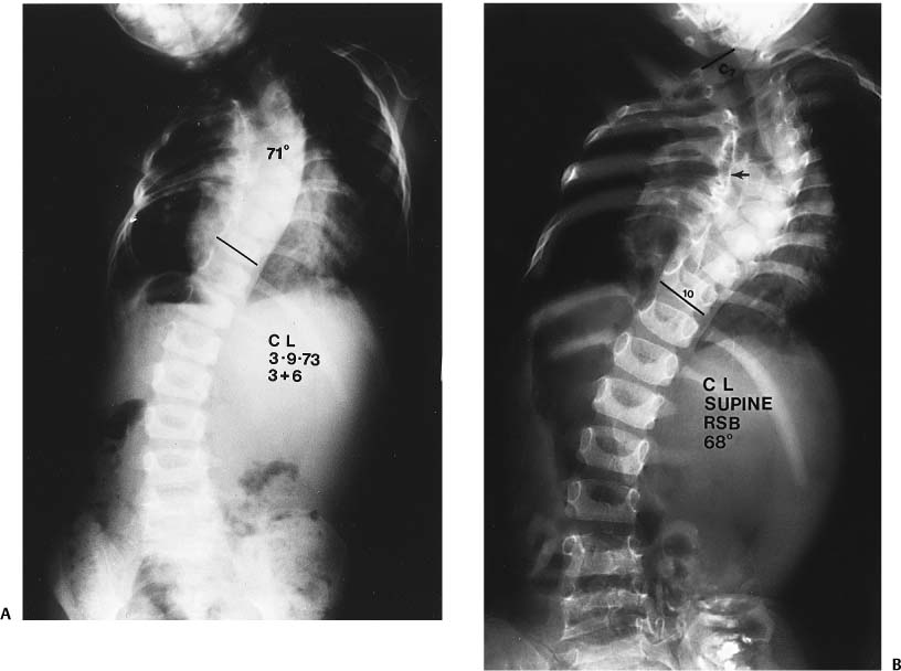 Congenital Scoliosis | Neupsy Key