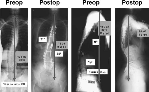 Adult Spinal Deformity Revision Surgery | Neupsy Key