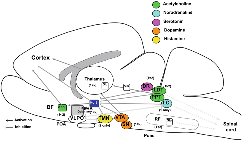 narcolepsy with cataplexy type 1