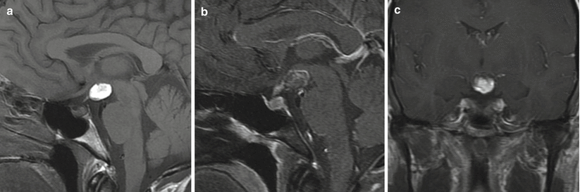 Sellar Region Epidermoid And Dermoid Cysts Neupsy Key