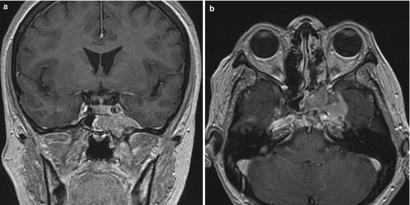 Nasopharyngeal Carcinoma And Squamous Cell Carcinoma Of The Paranasal