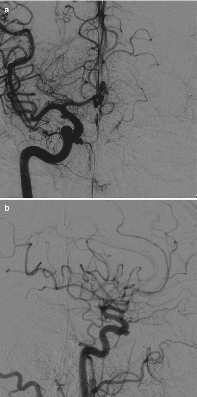 Pseudoaneurysms of the Internal Carotid Artery in the Sellar Region ...