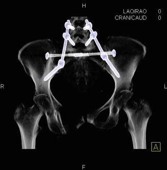 Percutaneous Sacropelvic Fixation Neupsy Key