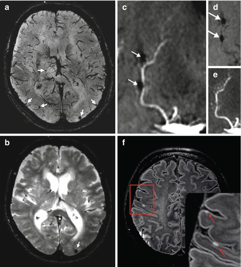 Resolution Imaging of Cerebral Small Vessel Disease with 7 T MRI