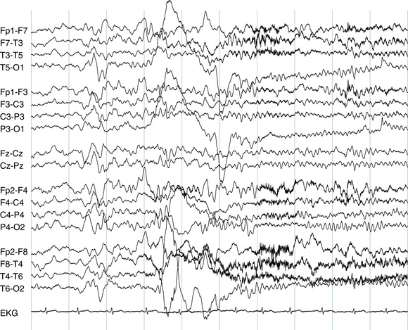 Visual Analysis of the EEG: | Neupsy Key