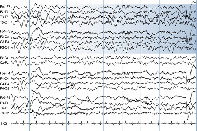 Normal Versus Abnormal Eeg