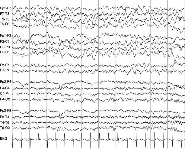 What Does An Abnormal Eeg Look Like