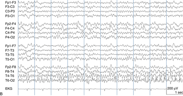 The EEG in Epilepsy | Neupsy Key
