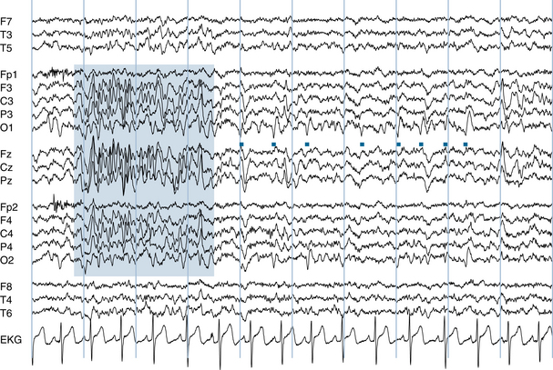 Normal Variants in the Electroencephalogram | Neupsy Key