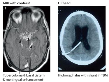 NEUROLOGICAL INFECTIONS | Neupsy Key