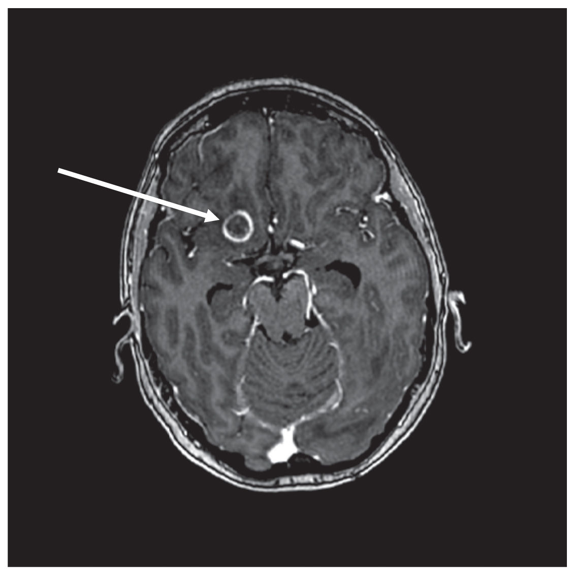 Cerebral abscesses imaging: A practical approach