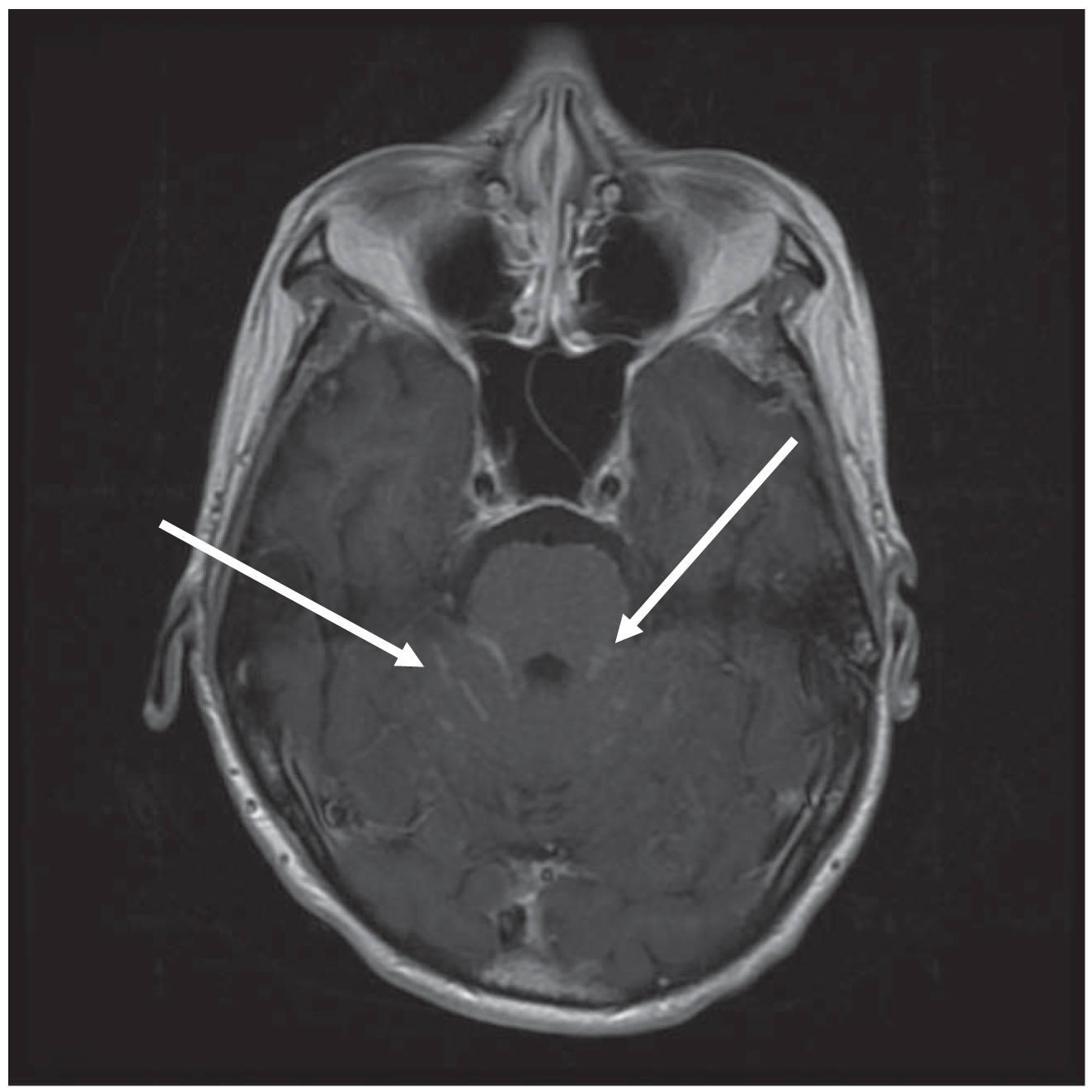 Nervous System Complications of Cancer | Neupsy Key