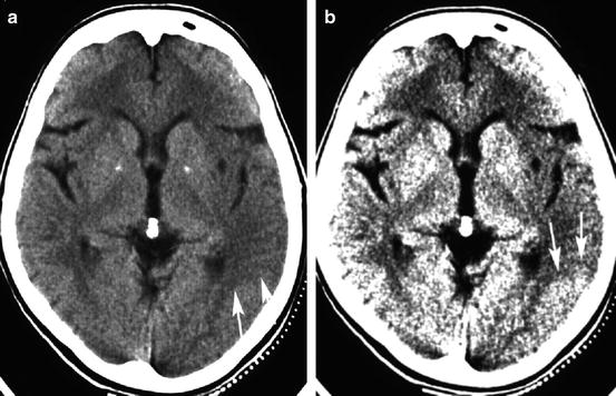 The Impact of Neuroimaging on Acute Stroke Treatment: Role of Computed ...