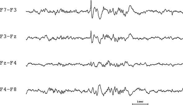 Localization and Field Determination in Electroencephalography | Neupsy Key