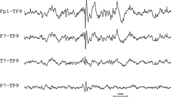 Localization and Field Determination in Electroencephalography | Neupsy Key