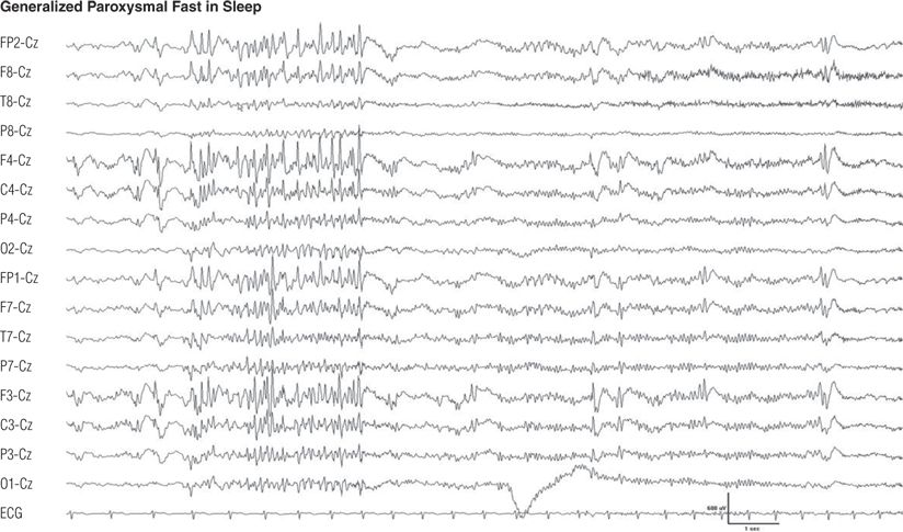 Electroencephalographic Atlas of Epileptiform Abnormalities | Neupsy Key