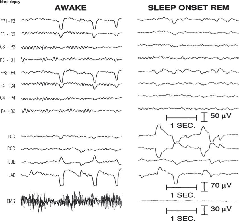 Electroencephalographic Atlas Of Epileptiform Abnormalities | Neupsy Key