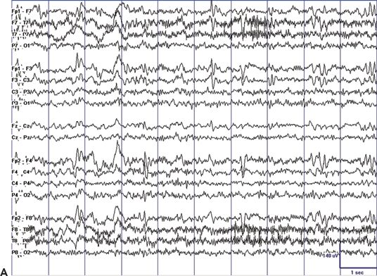 Continuous Spike-and-Wave During Sleep Including Landau–Kleffner ...